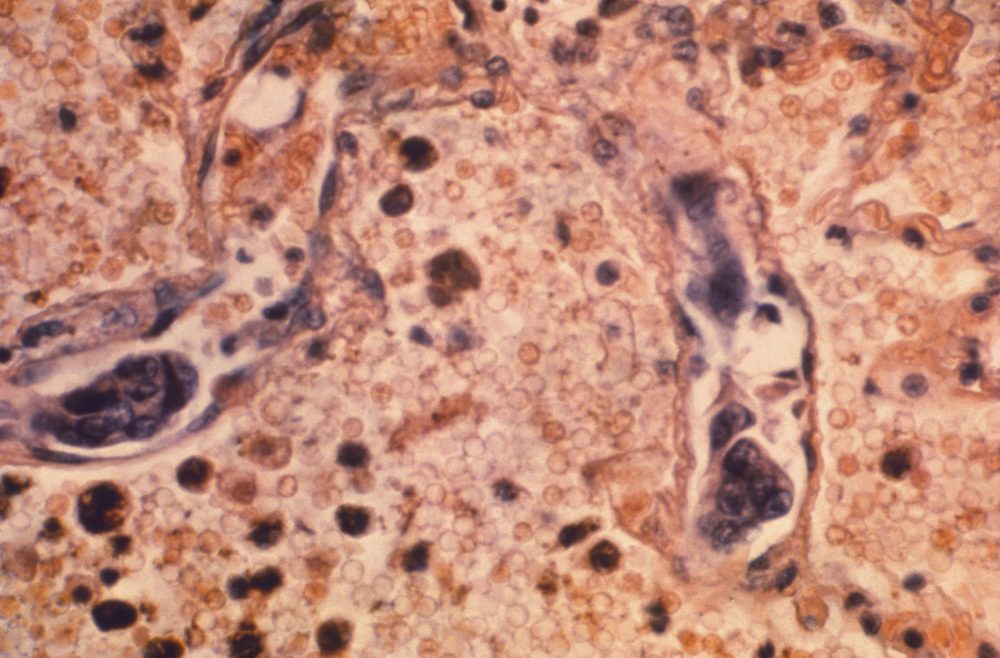 Lung_Cancer_22493