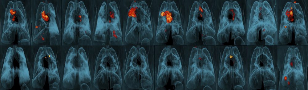 Tuberculosis_Vaccine_16382